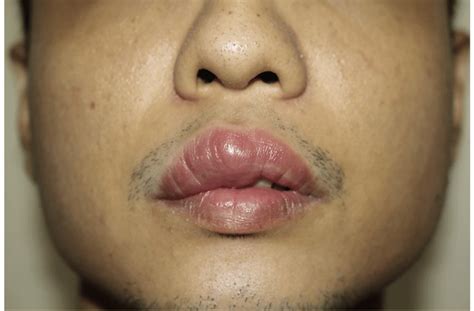 Causes Of Swollen Lips Upper | Lipstutorial.org