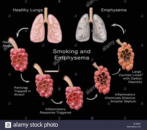 Stages Of Lung Damage Of A Smoker Leading To Emphysema The Stock – Best ...