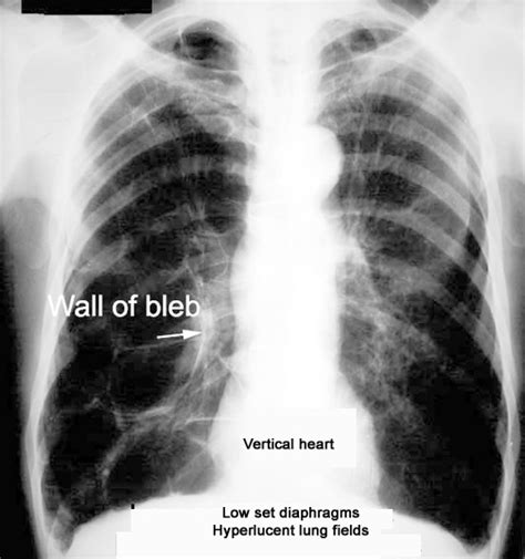 Low set diaphragm Flat diaphragm best determined by lateral chest Hyper ...