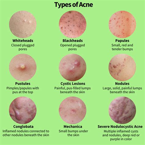 All About Acne Part 1: The Causes