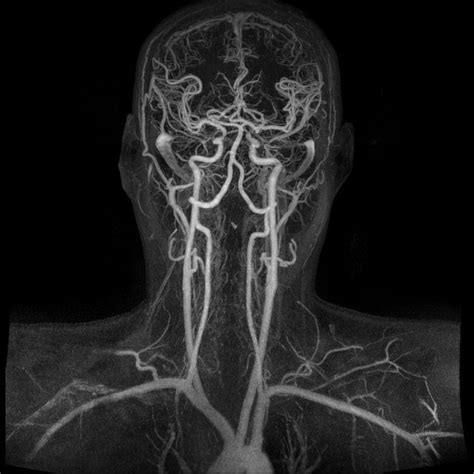 Magnetic Resonance Angiography is so cool : r/MRA