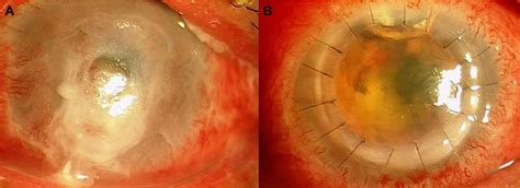 Corneal Perforation | Semantic Scholar