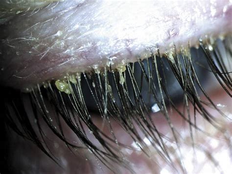 Demodex Eyelash Mites