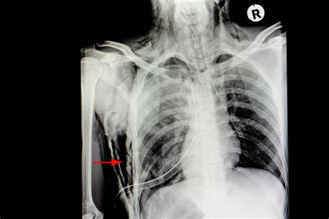 Subcutaneous Emphysema: Symptoms, Causes, and Treatment