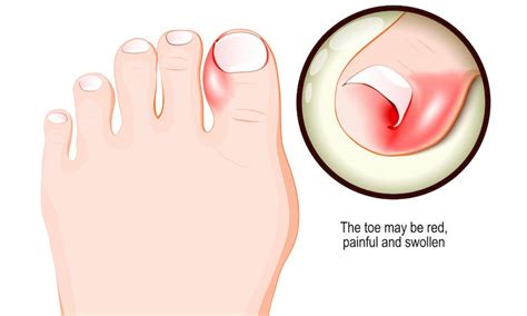 Ingrown Toenail GP | Doctors of South Melbourne