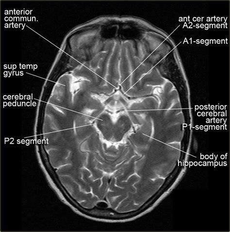 Anatomy Of Brain Ct Scan Anatomy Drawing Diagram | Images and Photos finder