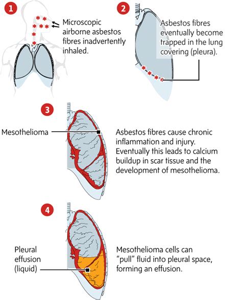 Emphysema Stages Of Death