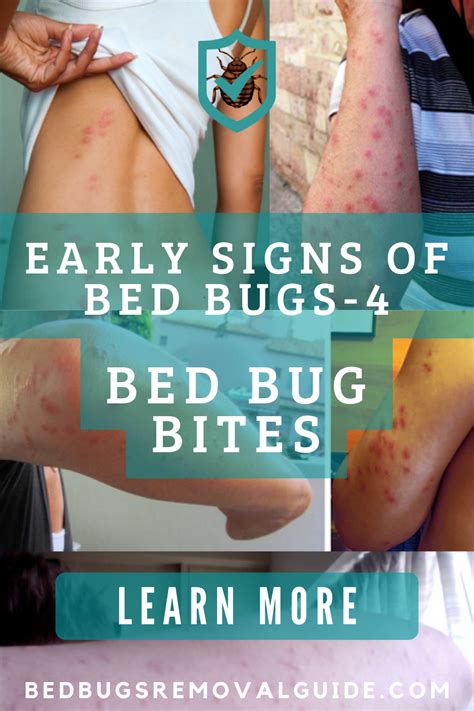 Early Signs Of Bed Bugs-4: Bed Bug Bites | Bed bug bites, Signs of bed ...