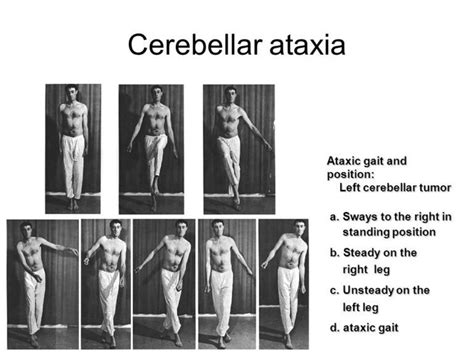 Cerebeller Ataxia : Cause,Symptom's,Diagnosis, Physiotherapy Treatment