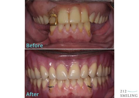 Dentures and Partial Dentures Male Before and After - 212 Smiling