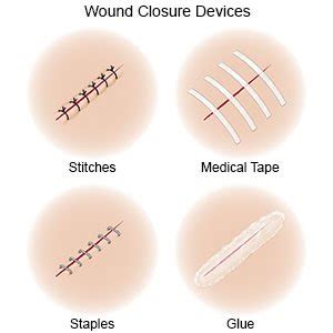 Care for your Stitches - What You Need to Know