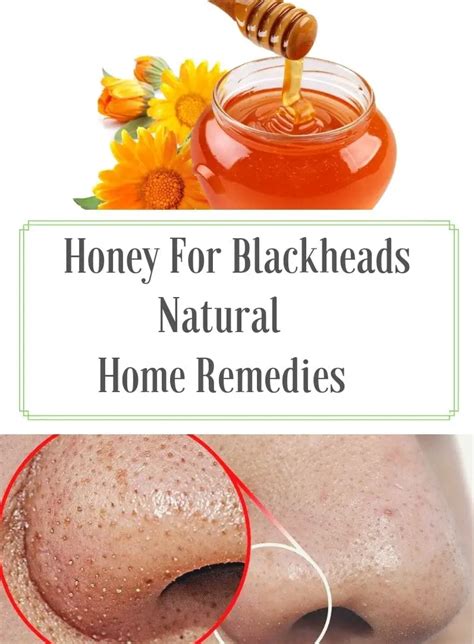 How To Remove Blackheads? - Home Remedies With Honey