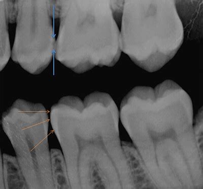 Cavity X Ray