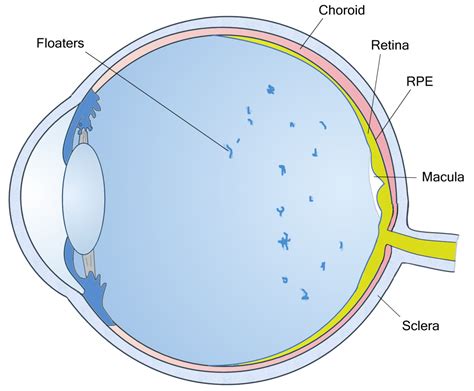 Eye Floater Prevention, Symptoms & News