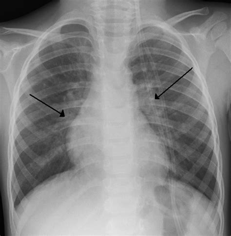 Bronchiolitis Chest X Ray