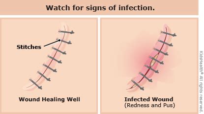 When Does a Cut Need Stitches? (for Parents) | Nemours KidsHealth