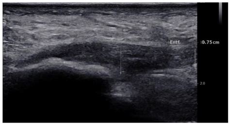 Plantar Fasciitis Ultrasound-Guided Injection Procedures ...