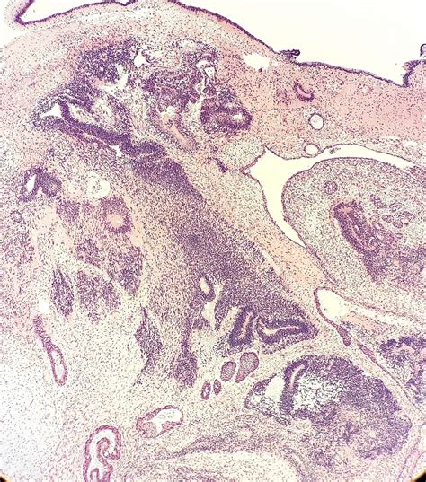 Immature Teratoma Histology