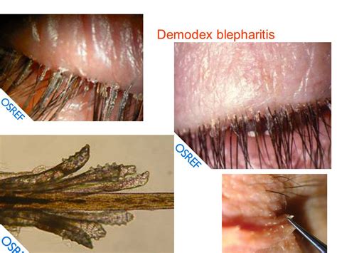 25 Images Demodex Scalp Symptoms - Demodectic Mange