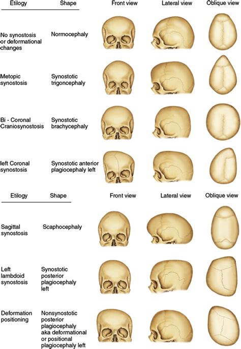 Craniofacial Anomalies | Plastic Surgery Key