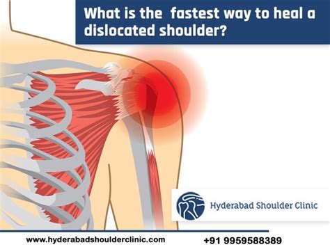 How Long Does It Take To Recover A Dislocated Shoulder?