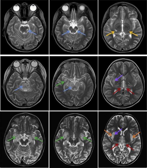 Mri Scans Explained