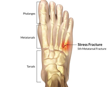 stress fracture - Runner's Tribe