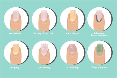 Psoriatic Arthritis Nail Changes: Symptoms and Treatments