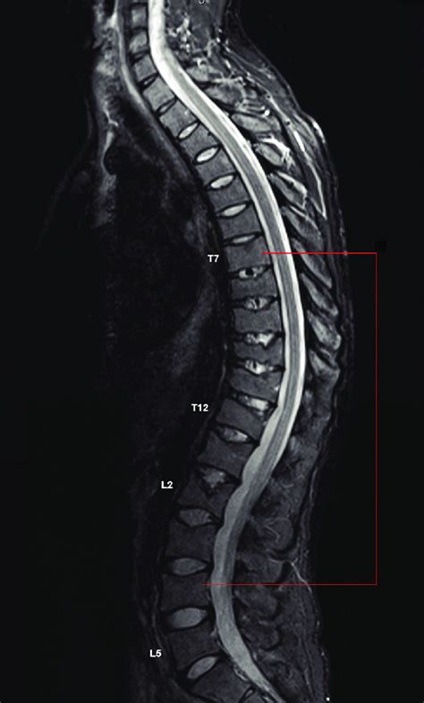 MRI of the thoracic and lumbar spine. | Download Scientific Diagram