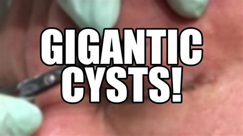 GIGANTIC Dermoid Cysts! Pimple Popping & Acne Video - YouTube