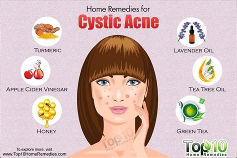 Home Remedies for Cystic Acne | Top 10 Home Remedies