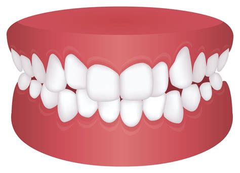 The Different Types of Bite Problems | Flower Mound Orthodontist