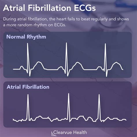 4 Charts | AI Diagnoses Atrial Fibrillation in Normal Sinus Rhythm ...