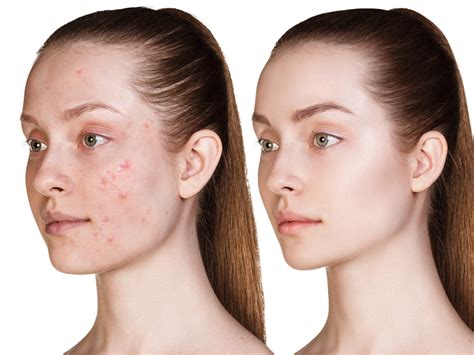 Laser Acne Treatment: Baton Rouge, LA | Body Image Aesthetics