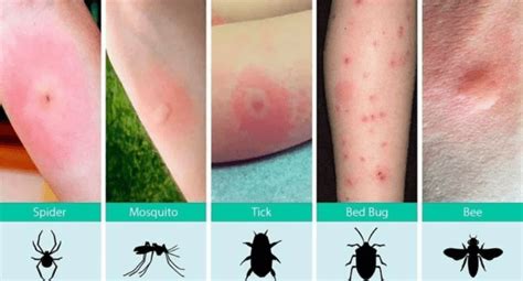 Bed Bug Bites vs. Flea Bites | 3 Critical Differences To Know [With ...