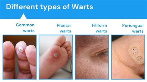 Warts Turned White at Diana Olsen blog