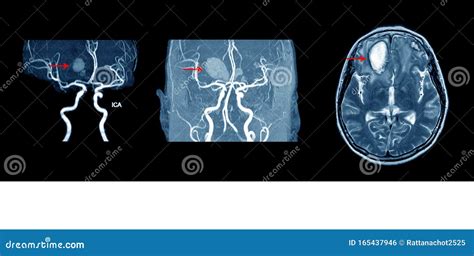 MRA and MRV of BRAIN stock photo. Image of hospital - 165437946