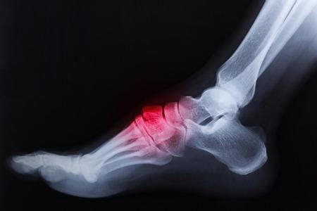 I Need Foot and Ankle Surgery. Now What?: Stavros Alexopoulos, D.P.M ...