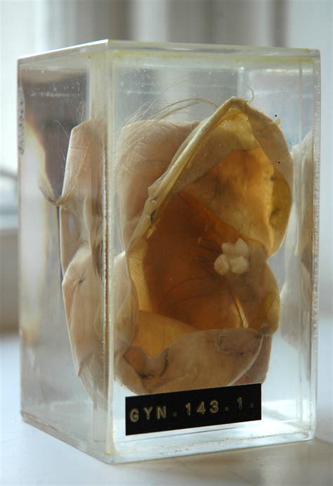 Teratoma with Tooth and Hair | UCL Researchers in Museums