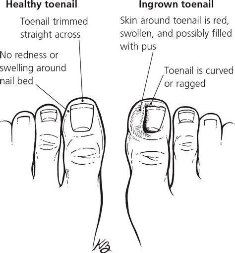 Mild Ingrown Toenail