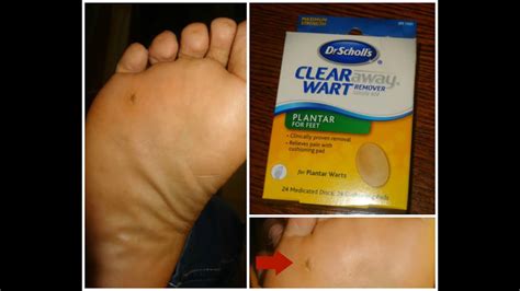 Dr Scholl S Plantar Wart Removal Freeze Away | Bruin Blog