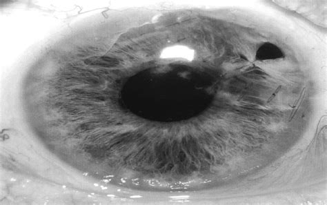 Corneal Perforation Due to Severe Peripheral Ulcerative Kera... : Cornea