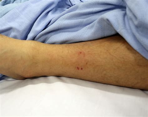 Moranbah man survives deadly snake bite - Mackay Hospital and Health ...