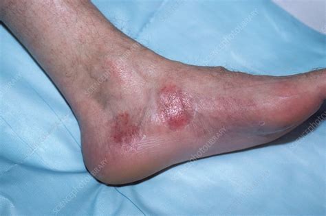 Psoriatic arthritis - Stock Image - C018/7159 - Science Photo Library