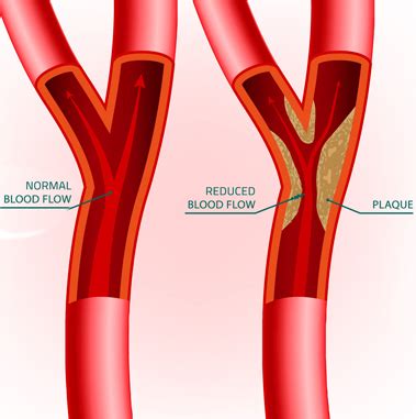 Carotid Artery Stenosis Wikipedia, 55% OFF