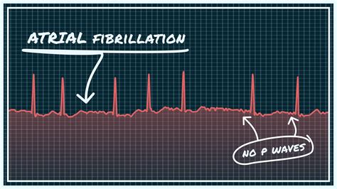 Is A-fib Considered Heart Disease for Life Insurance? – Promt Insurance