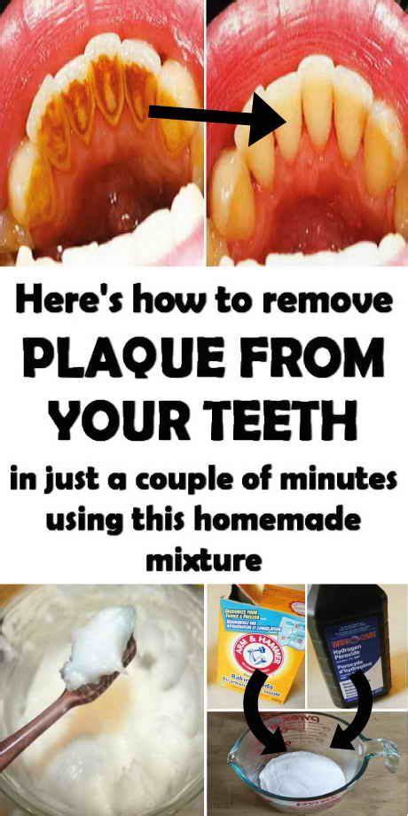 How To Remove Tartar From Teeth Diy - HOWTOREMVO