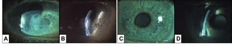 Bilateral corneal perforation. A: Diffuse illumination of the right eye ...