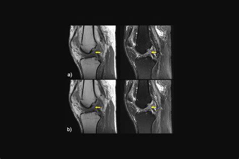 Artificial Intelligence Reconstructs Missing Data from Rapid MRI Scans ...