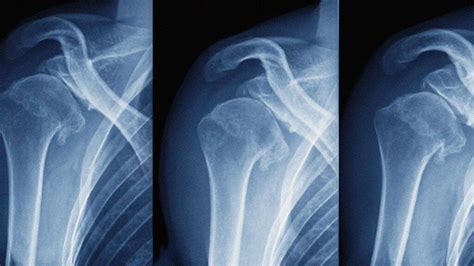 Dislocated shoulder: What to do, symptoms, treatment, and more